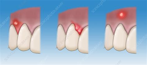 Types Of Dental Abscesses Illustration Stock Image C0366295
