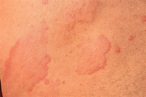 Can Stress Cause Hives What To Know About Stress Hives The Healthy