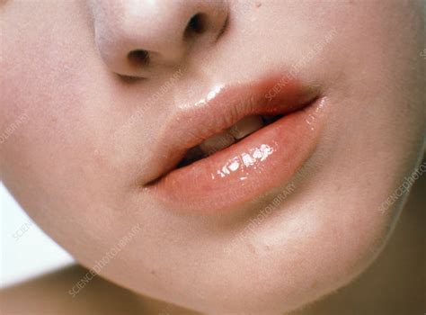 Womans Lip Affected By Herpex Simplex Stock Image M1700239