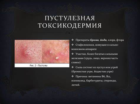 Токсикодермия лечение и диета Токсикодермия (токсико-аллергический дерматит) - презентация онлайн Токсикодермия (токсико-аллергический дерматит) - презентация онлайн Токсикодермия лечение и диета