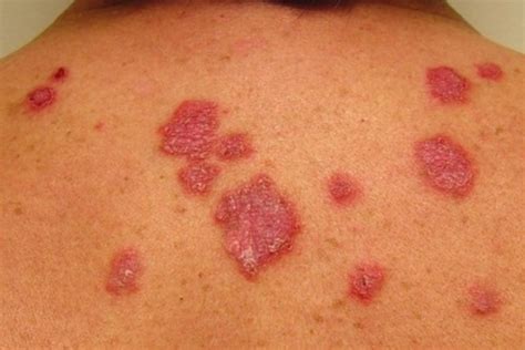 Red Spots On Skin 18 Causes With Pictures And Treatment Tua Saúde
