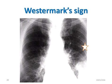 Pulmonary Embolism