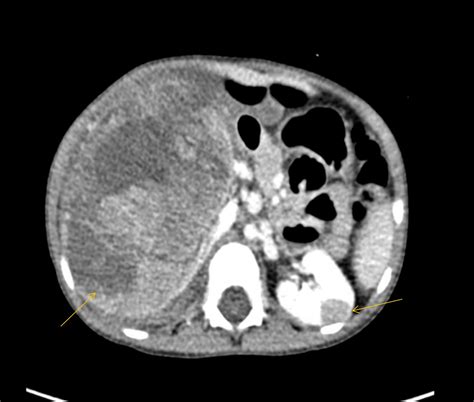 Cureus Bilateral Wilms Tumor With Different Responses To