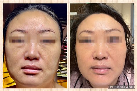 Wrinkle Reduction And Skin Tightening Natural Rejuvenation Medspa™