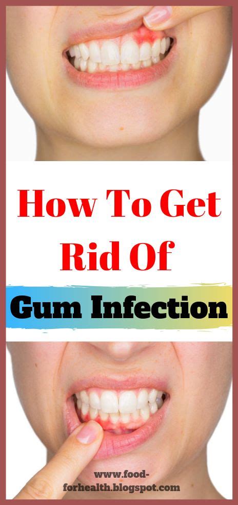 There You Have It How To Get Rid Of Gum Infection If You Liked This