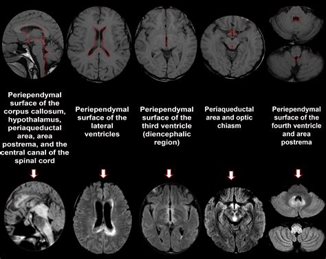 Neuromyelitis Optica Spectrum Disorders Spectrum Of Mr Imaging