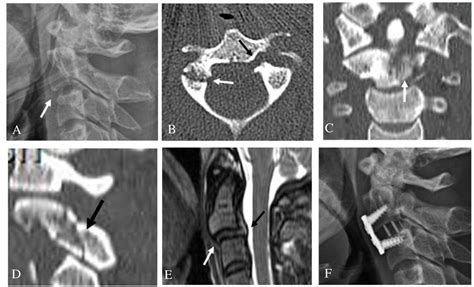 Jcm Free Full Text Proposal Of Treatment Strategy For Pedicle