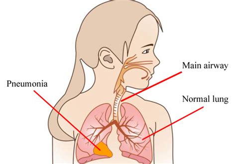 Other symptoms can include fever, nasal discharge, weeping eyes and an abnormal shaking. What Does Pneumonia Cough Sound Like In Adults ...
