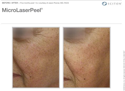 Micro Laser Peel Before After 2 Robinson Fps