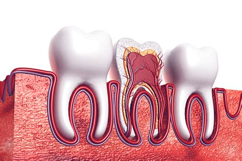 A root canal removes infected and inflamed dental pulp, essentially hollowing out your tooth (and sometimes removing much of the natural tooth material). Does a Root Canal Hurt | Penn Dental Family Practice