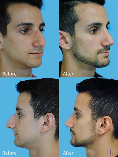 This Patient Was Unhappy With His Large Nose And Dorsal Hump 3 Months