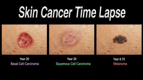 Skin Cancer Time Lapse Basal Cell Carcinoma Squamous Cell Carcinoma