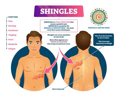 Shingles And Shingrix Everything People Need To Know Lompoc Valley