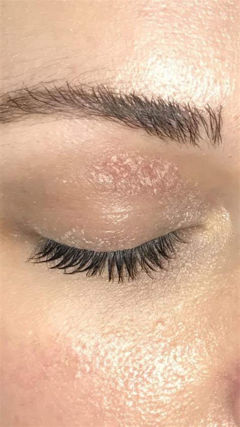 Round Patch Of Dry Skin On Eyelid