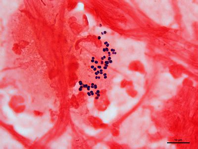 Usually, they are seen as pairs of cocci (diplococci), but they may also occur singly and in short chains. Gram negative pneumonia