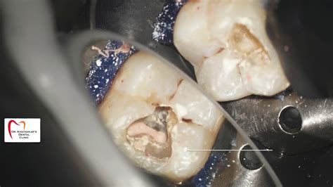 Post Endodontic Restoration Mandibular Molar Sdr Plus Spectrum