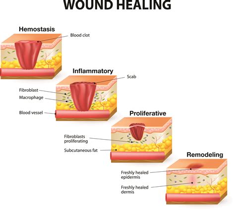 If the tree is simply scratched, wash the wound out with plain soap and water to help reduce the amount of pathogens that may be in the scratch and that could cause further damage. How Wounds Heal: The 4 Main Phases of Wound Healing ...
