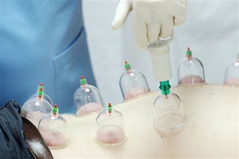 5 Reasons You Should Try Cupping Therapy Hijama Home