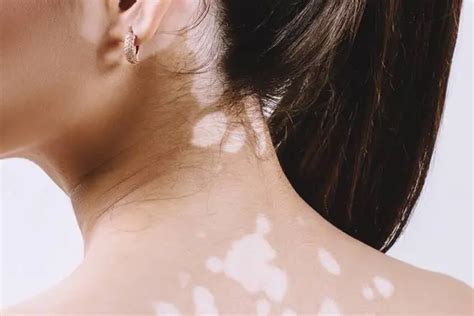 World Vitiligo Day 2019 Be Informed Vitiligo Or Leucoderma Is Not