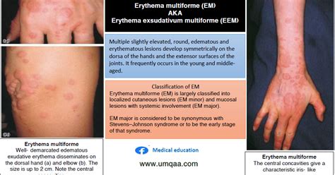 Erythema Multiforme Causes Symptoms And Possible Treatments Gambaran