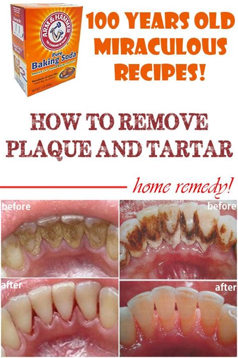 Your dentist or dental hygienist uses instruments during regular dental checkups to find. How To Get Hard Plaque Off Teeth At Home - TeethWalls
