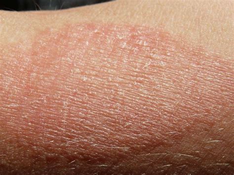 Many Common Issues Can Cause Patches Of Dry Skin Including Cold