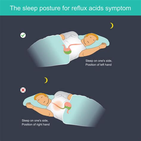 What Is The Best Sleeping Position If I Have Acid Reflux