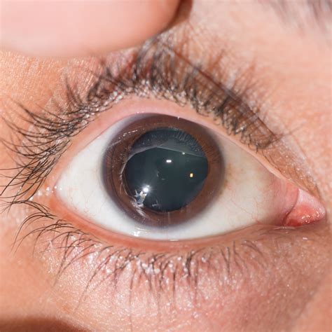 Mydriasis Dilated Pupils Causes And Treatment