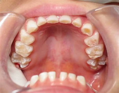 How Can Grinding Teeth Cause Tooth Pain Surprising Reason