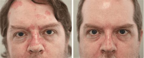 Treatment For Eczema And Psoriasis Pharos Excimer Laser