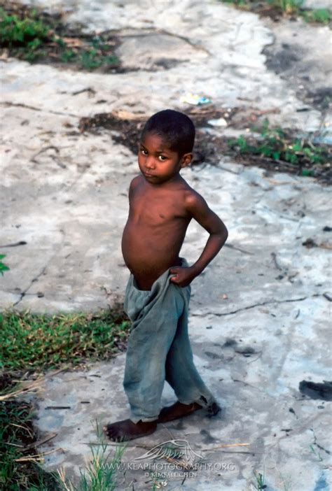 Big Belly Kid In Madagascar Africa Kea Photography