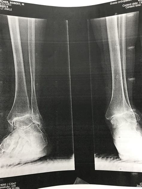 Total Ankle Replacement Arthroplasty Shasta Orthopaedics