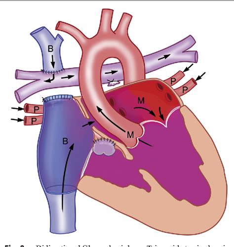 Table 1 Cardiac Lesions Leading To Single Ventricle Physiology Single