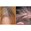 How To Treat Itchy Scalp  Medical Overview And Treatments