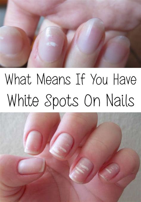 Im Sure Many Times You Noticed Some White Spots On Your Nails What