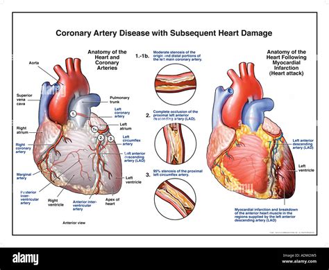 Koronare Herzkrankheit Mit Nachfolgenden Herzschäden Stockfoto Bild