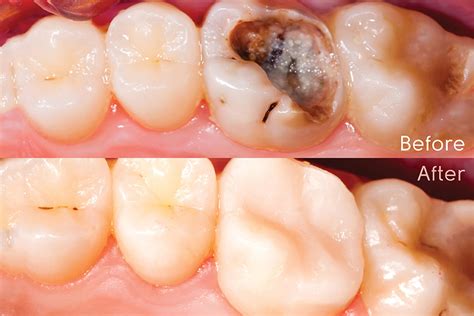 Ada Nsw Direct And Indirect Resin Composite Restorations