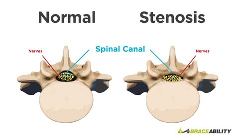 Spinal Stenosis What Causes Narrowing Of Your Spine Or Backbone