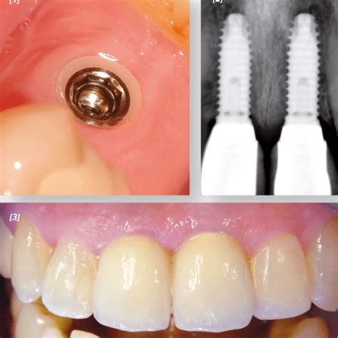 Z1 Tissue Level Implants Tbr Dental
