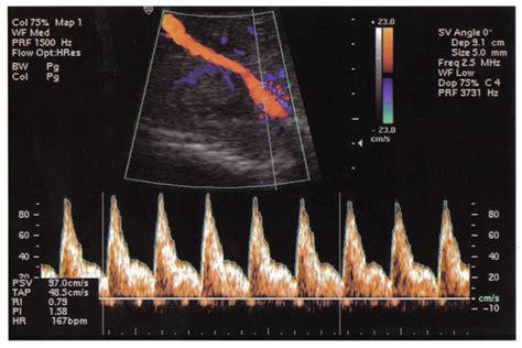 Velocimetr A Doppler De Las Arterias Uterinas En El Embarazo