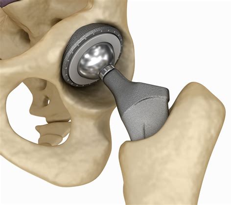 Joint Replacements Progression Muscle Bone And Joint Clinic