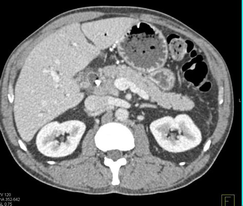 Pancreatic Cancer With Normal Vascular Map Pancreas Case