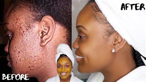 How To Get Rid Of Acne Scars And Dark Marks Fast Diy Turmeric Honey