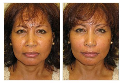 Before After Restylane Pacific Dermatology Center