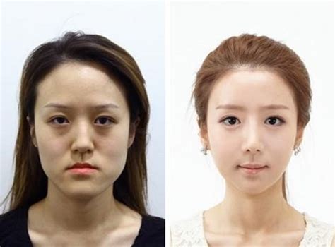 China To Be The Third Largest Country Of Plastic Surgery 2 Peoples