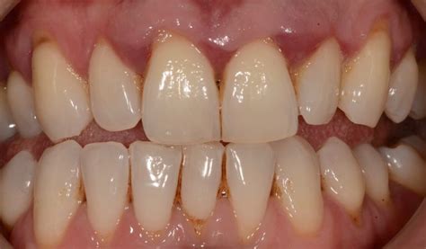 Possible Reasons For A Receding Gum Line Balsall Common Dental