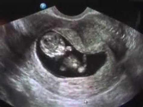 Pregnancy ultrasound middle aged woman pregnant pregnant ultrasound fetus ultrasound middle age pregnancy scan baby ultrasound of baby in mother's womb pregnancy baby womb sonogram ultrasound pregnancy. Dancing Ultrasound Baby - YouTube