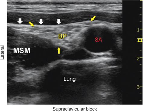 Ultrasound Guided Supraclavicular Brachial Plexus Block Anesthesia Key