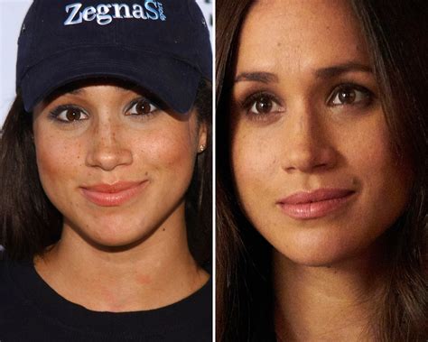 Meghan Markle Before And After Nose Job Job Retro