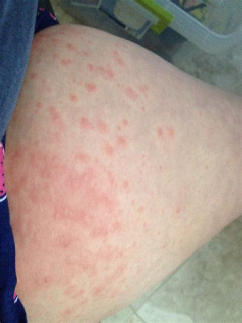 Pruritic Urticarial Papules And Plaques Of Pregnancy Puppp Rash